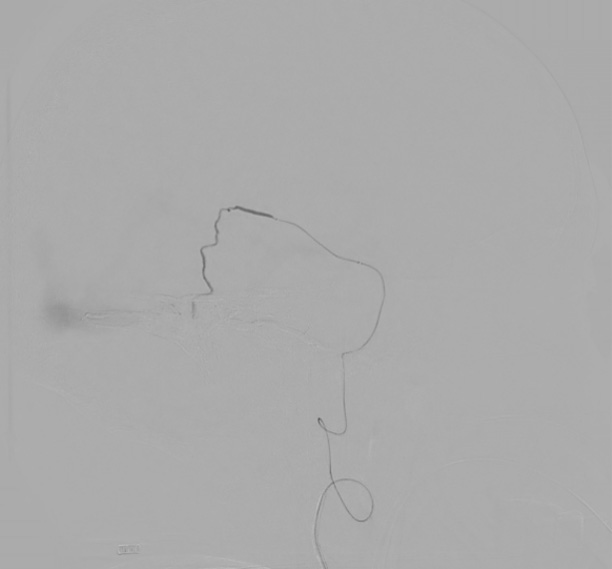Complex Dural Arterio-Venous fistula- An Unusual Cause of Ischemic Stroke