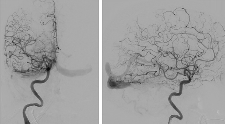 Complex Dural Arterio-Venous fistula- An Unusual Cause of Ischemic Stroke