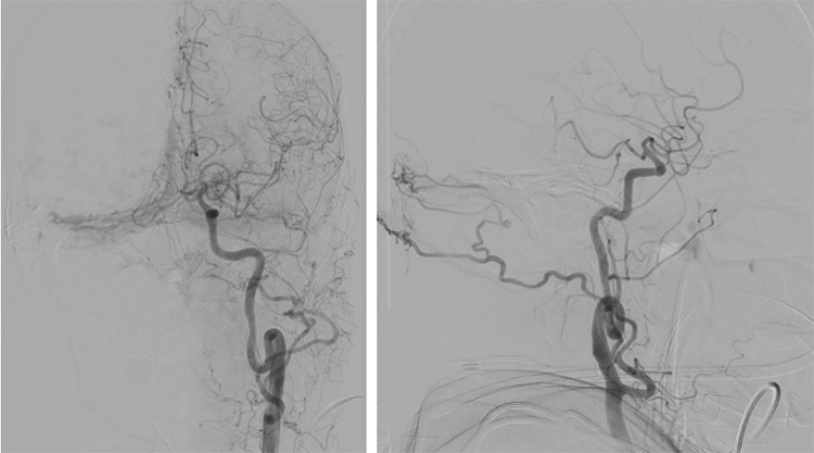 Complex Dural Arterio-Venous fistula- An Unusual Cause of Ischemic Stroke
