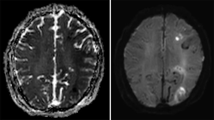 Complex Dural Arterio-Venous fistula- An Unusual Cause of Ischemic Stroke