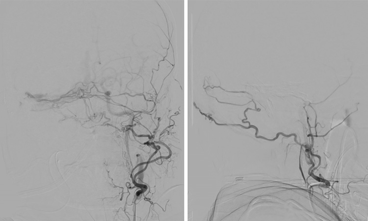 Complex Dural Arterio-Venous fistula- An Unusual Cause of Ischemic Stroke