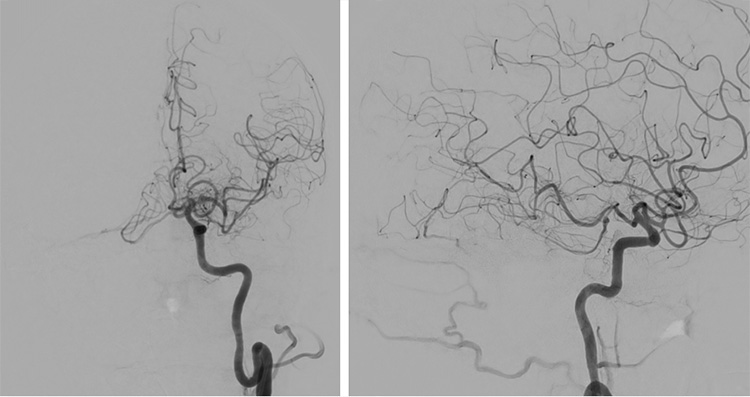 Complex Dural Arterio-Venous fistula- An Unusual Cause of Ischemic Stroke