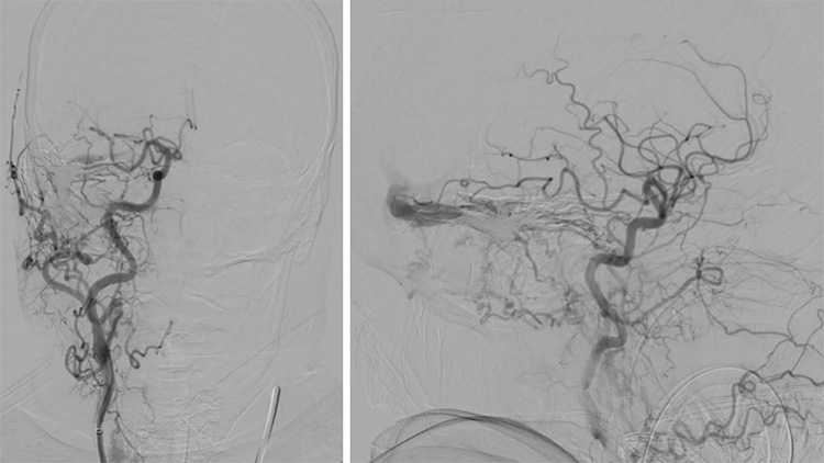 Complex Dural Arterio-Venous fistula- An Unusual Cause of Ischemic Stroke
