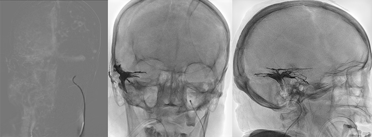 Complex Dural Arterio-Venous fistula- An Unusual Cause of Ischemic Stroke