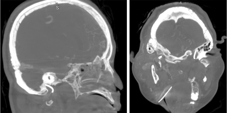 Complex Dural Arterio-Venous fistula- An Unusual Cause of Ischemic Stroke