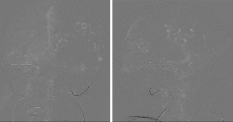 Complex Dural Arterio-Venous fistula- An Unusual Cause of Ischemic Stroke