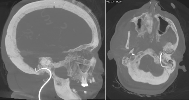Complex Dural Arterio-Venous fistula- An Unusual Cause of Ischemic Stroke