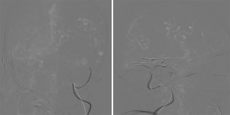 Complex Dural Arterio-Venous fistula- An Unusual Cause of Ischemic Stroke