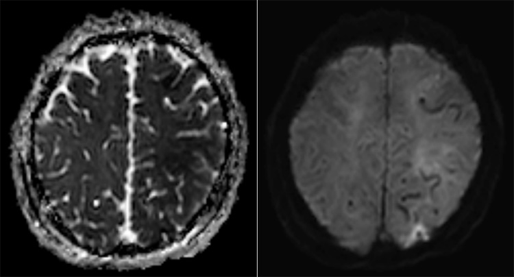 Complex Dural Arterio-Venous fistula- An Unusual Cause of Ischemic Stroke