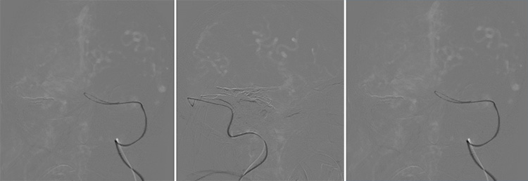 Complex Dural Arterio-Venous fistula- An Unusual Cause of Ischemic Stroke