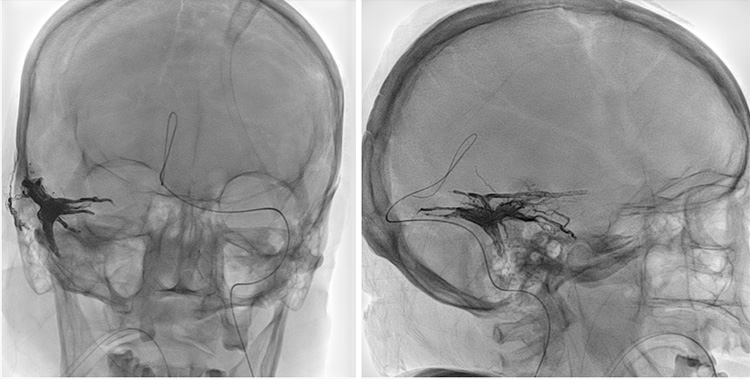 Complex Dural Arterio-Venous fistula- An Unusual Cause of Ischemic Stroke