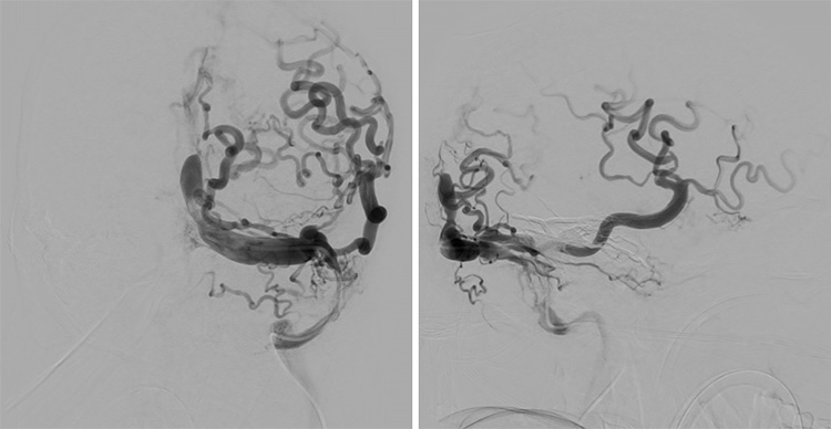 Complex Dural Arterio-Venous fistula- An Unusual Cause of Ischemic Stroke
