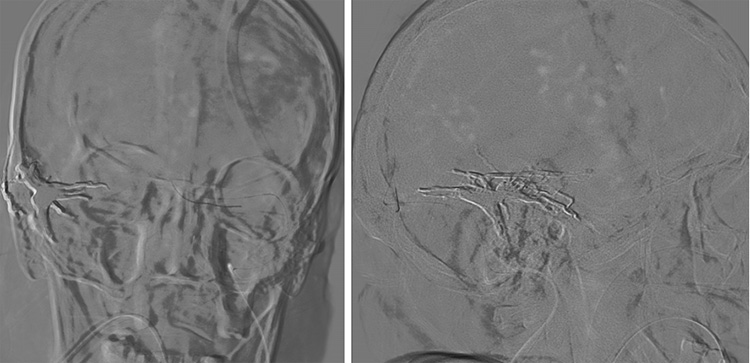 Complex Dural Arterio-Venous fistula- An Unusual Cause of Ischemic Stroke