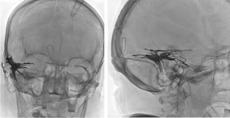 Complex Dural Arterio-Venous fistula- An Unusual Cause of Ischemic Stroke