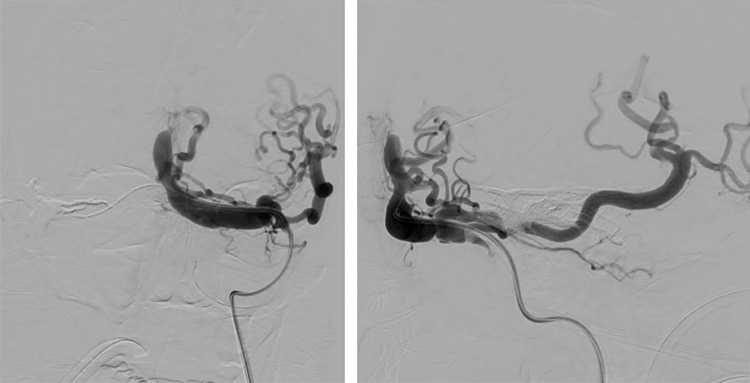 Complex Dural Arterio-Venous fistula- An Unusual Cause of Ischemic Stroke
