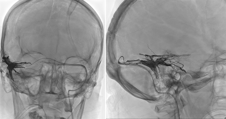 Complex Dural Arterio-Venous fistula- An Unusual Cause of Ischemic Stroke
