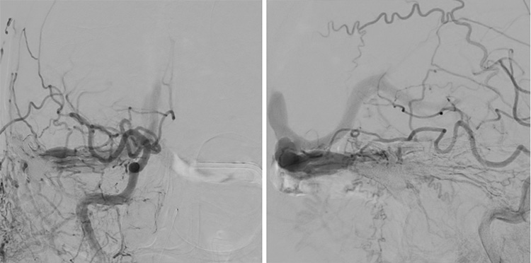 Complex Dural Arterio-Venous fistula- An Unusual Cause of Ischemic Stroke