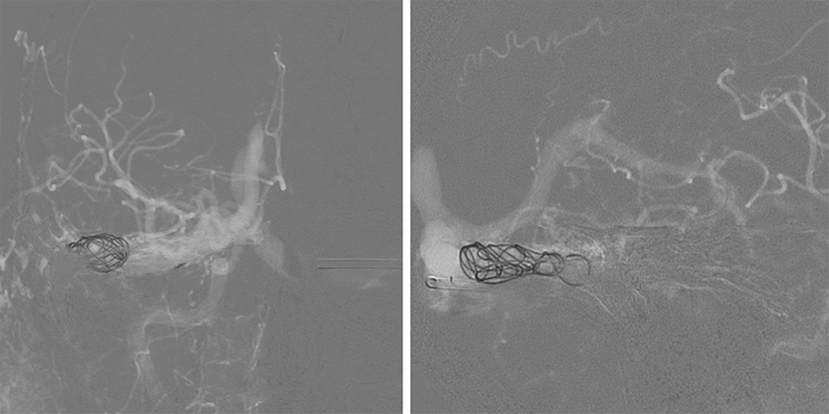 Complex Dural Arterio-Venous fistula- An Unusual Cause of Ischemic Stroke