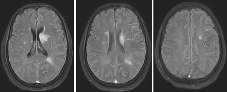 Complex Dural Arterio-Venous fistula- An Unusual Cause of Ischemic Stroke