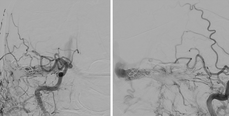 Complex Dural Arterio-Venous fistula- An Unusual Cause of Ischemic Stroke