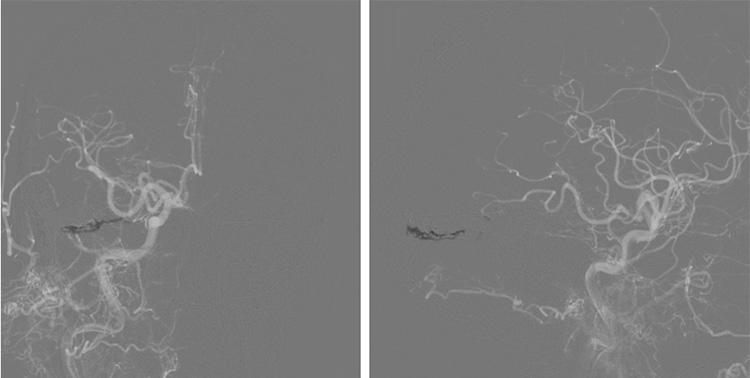 Complex Dural Arterio-Venous fistula- An Unusual Cause of Ischemic Stroke