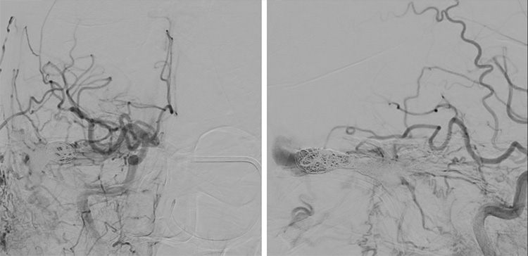 Complex Dural Arterio-Venous fistula- An Unusual Cause of Ischemic Stroke