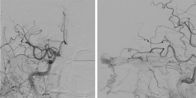Complex Dural Arterio-Venous fistula- An Unusual Cause of Ischemic Stroke
