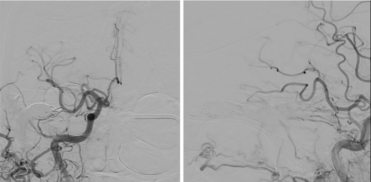 Complex Dural Arterio-Venous fistula- An Unusual Cause of Ischemic Stroke