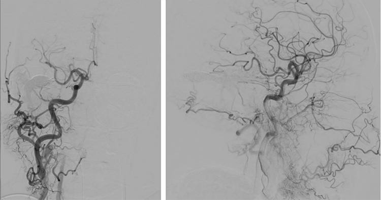 Complex Dural Arterio-Venous fistula- An Unusual Cause of Ischemic Stroke