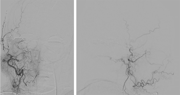 Complex Dural Arterio-Venous fistula- An Unusual Cause of Ischemic Stroke