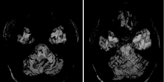 Complex Dural Arterio-Venous fistula- An Unusual Cause of Ischemic Stroke