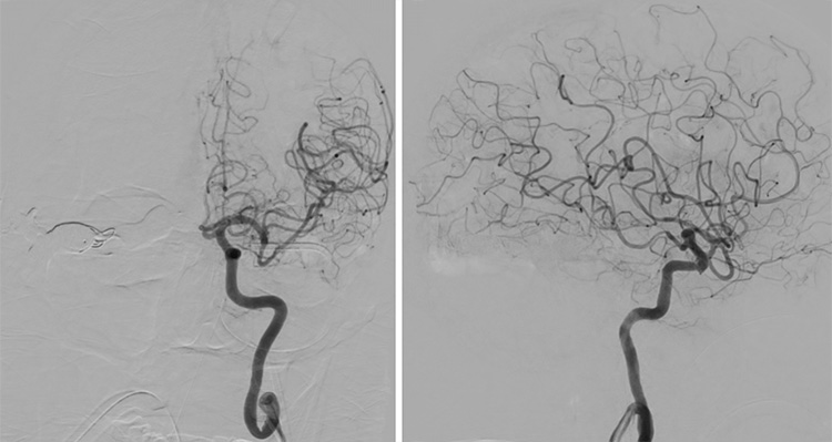 Complex Dural Arterio-Venous fistula- An Unusual Cause of Ischemic Stroke
