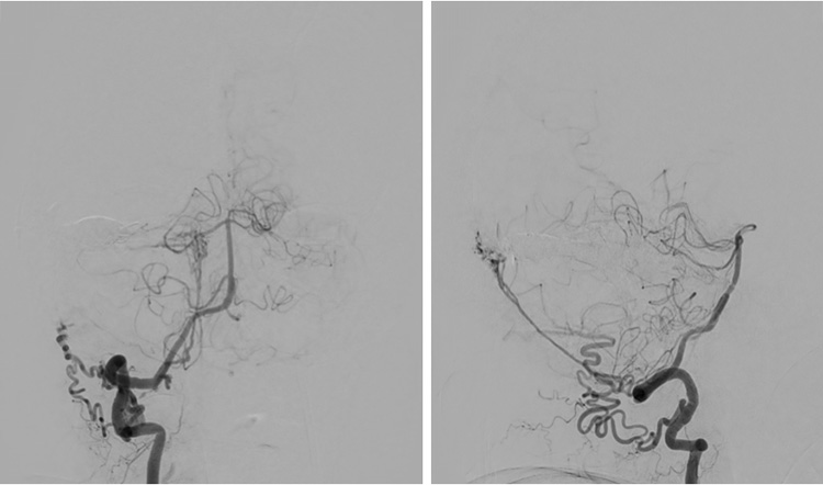 Complex Dural Arterio-Venous fistula- An Unusual Cause of Ischemic Stroke