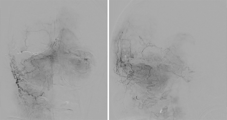 Complex Dural Arterio-Venous fistula- An Unusual Cause of Ischemic Stroke
