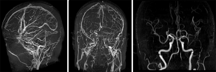 F/U MRI and MRV 11 month after embo