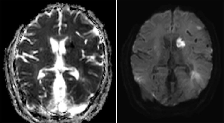 Complex Dural Arterio-Venous fistula- An Unusual Cause of Ischemic Stroke