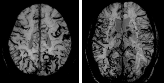Complex Dural Arterio-Venous fistula- An Unusual Cause of Ischemic Stroke