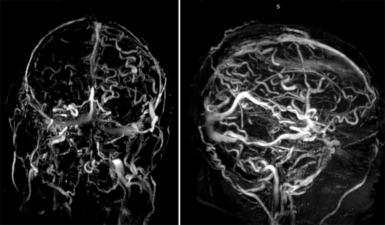 Complex Dural Arterio-Venous fistula- An Unusual Cause of Ischemic Stroke