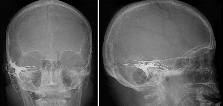 Complex Dural Arterio-Venous fistula- An Unusual Cause of Ischemic Stroke