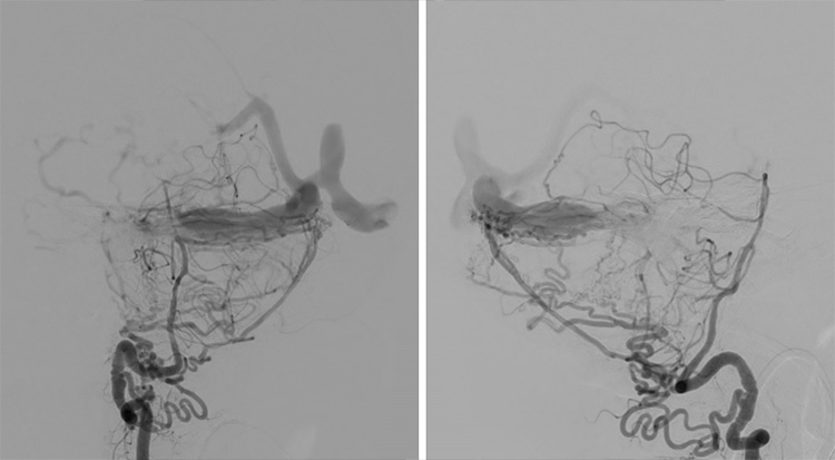 Complex Dural Arterio-Venous fistula- An Unusual Cause of Ischemic Stroke
