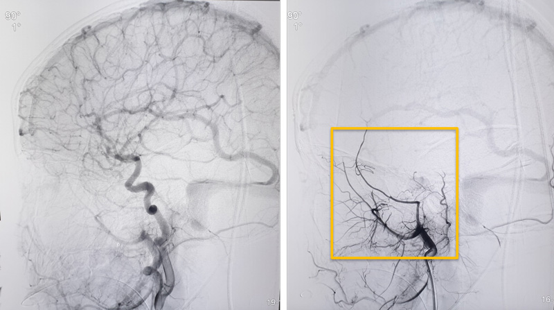 Control Angiogram R-CCA & R-ECA