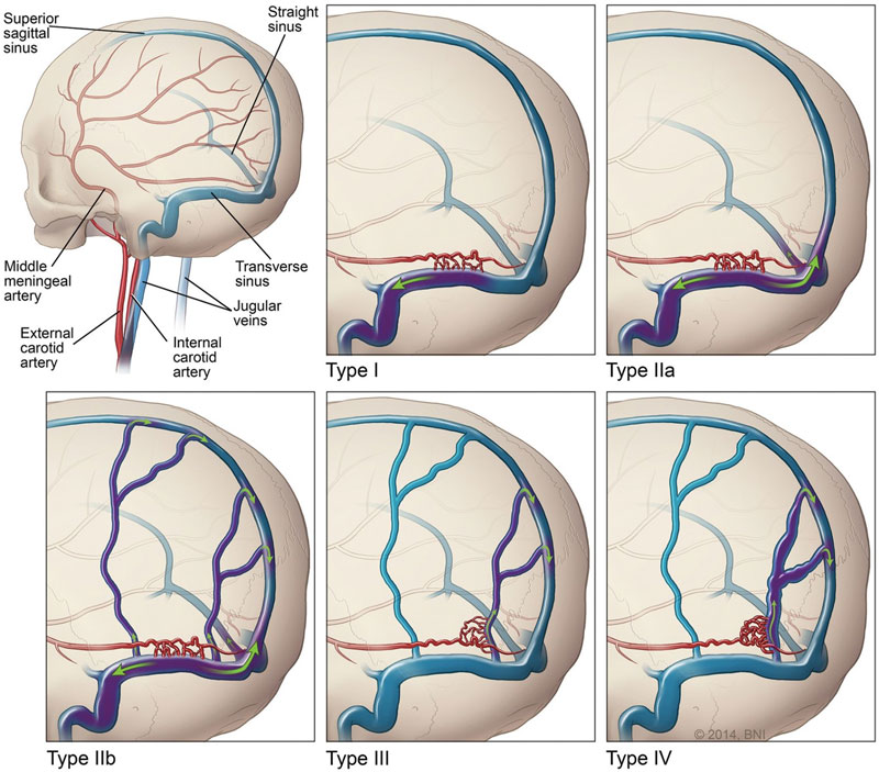Cranial dural AVF classification