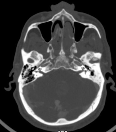 Brain CT angiography: Prominent vascular marker in posterior fossa