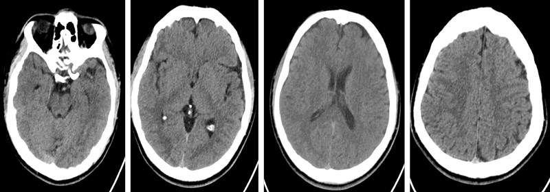 CT Brain