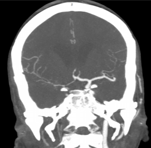 Vertebrogram Ipsilateral Transradial Approach For Management Of Ruptured Vertebro ...