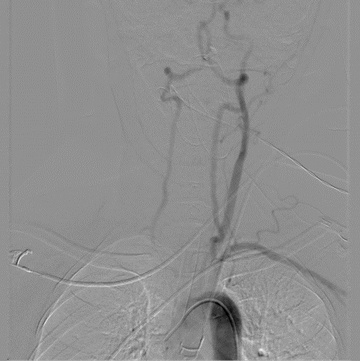 Delayed Aortic Run