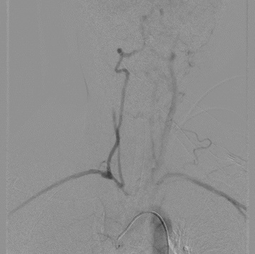 Delayed Aortic Run