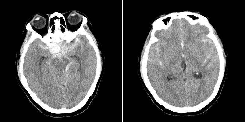 Delayed rupture with ICA occlusion