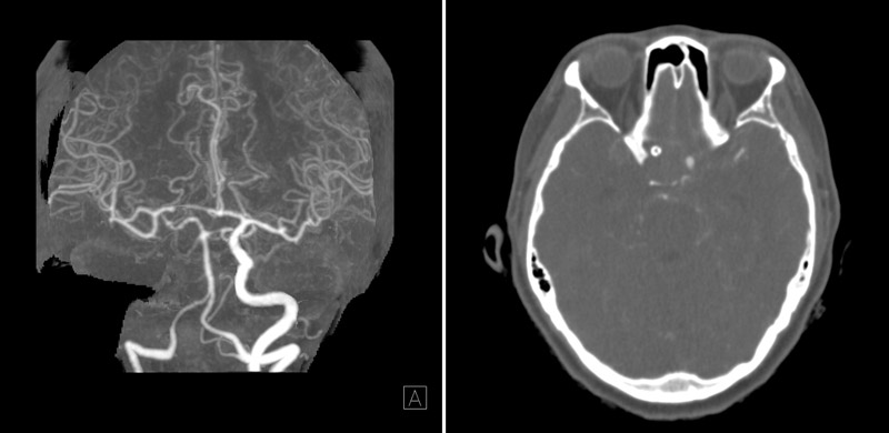 Delayed rupture with ICA occlusion