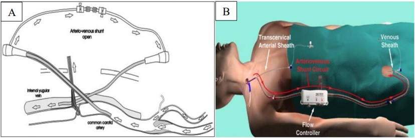 Diagram of transcervical carotid flow reversal technique